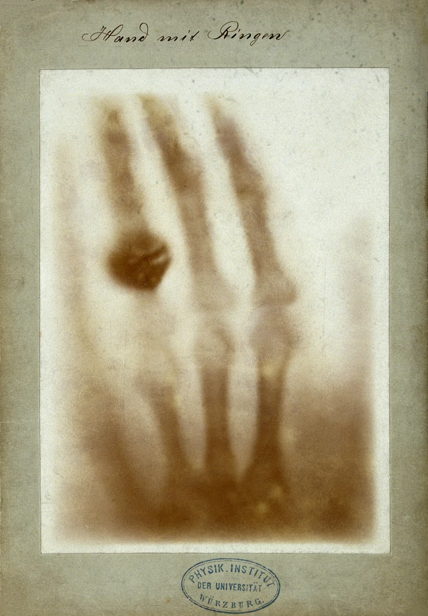 Primeira radiografia médica, a mão esquerda de Anna Bertha Ludwig com a aliança no dedo anular, feita por Wilhelm Conrad Röntgen em 22 de dezembro de 1895.
